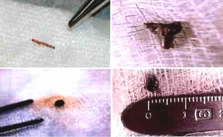 implantes extraterrestres